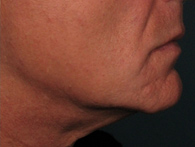 After Ultherapy skin tightening - San Diego Dermatology and Laser Surgery